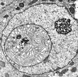 F,61y. | intranuclear cytoplasmic inclusion - giant cell hepatitis